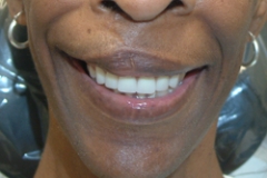 dentures_after15127a427d9e7f