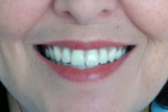 dentures_after25127a4272a252