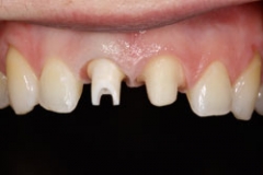 implant_abutments15127a30294910