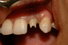 implant_abutments35127a302be1fd