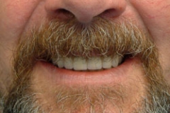 implants35127a3039ac62