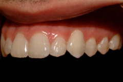 implants_smile15127a302e54db