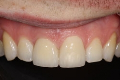 implants_smile25127a30316c56