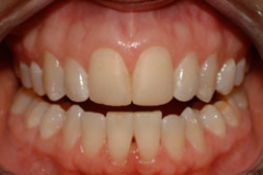 veneers25127a6f113b82