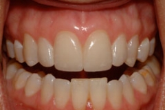 veneers5127a6f0eb39d
